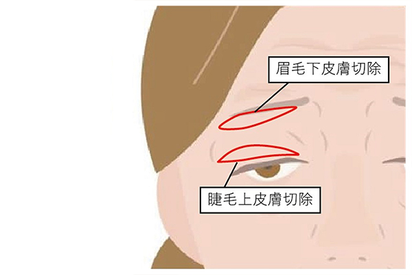 皮膚のたるみによる眼瞼下垂