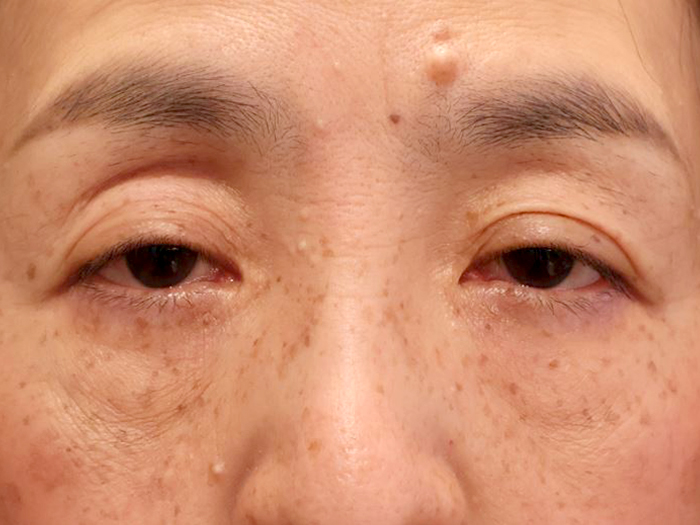 眼瞼下垂手術の症例 術前
