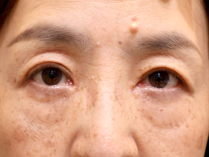 眼瞼下垂手術の症例 術後