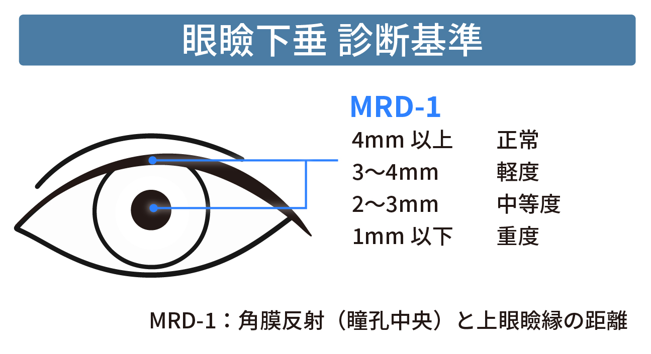 眼瞼下垂とは？