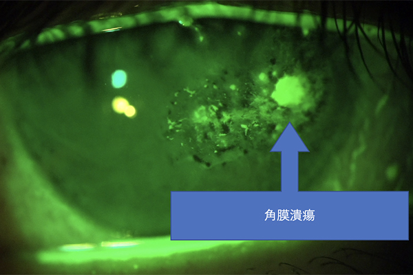 眼瞼下垂修正手術 術後