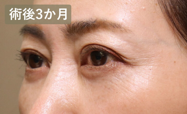 目の下のクマ取り・たるみ取り（ハムラ法）　症例4 After 2