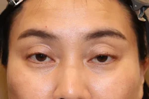 眼瞼下垂　症例19 Before