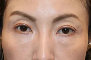眼瞼下垂　症例22 After