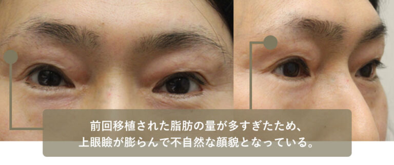 他院手術後修正　症例4 Before
