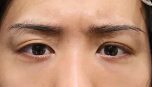 出目・はなれ目（眼球突出）　症例19 After