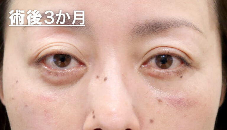 バセドウ病眼症・甲状腺眼症（目のクマ）　症例5 After