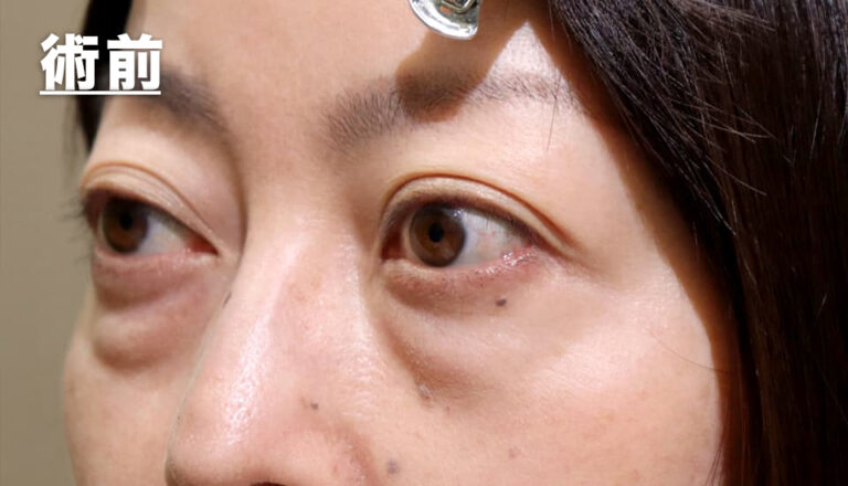 バセドウ病眼症・甲状腺眼症（目のクマ）　症例5 Before 2